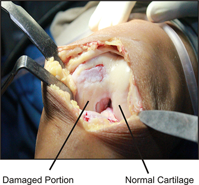 Partially damaged joint 2